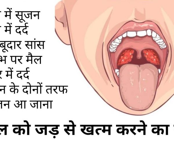 गले की सूजन में