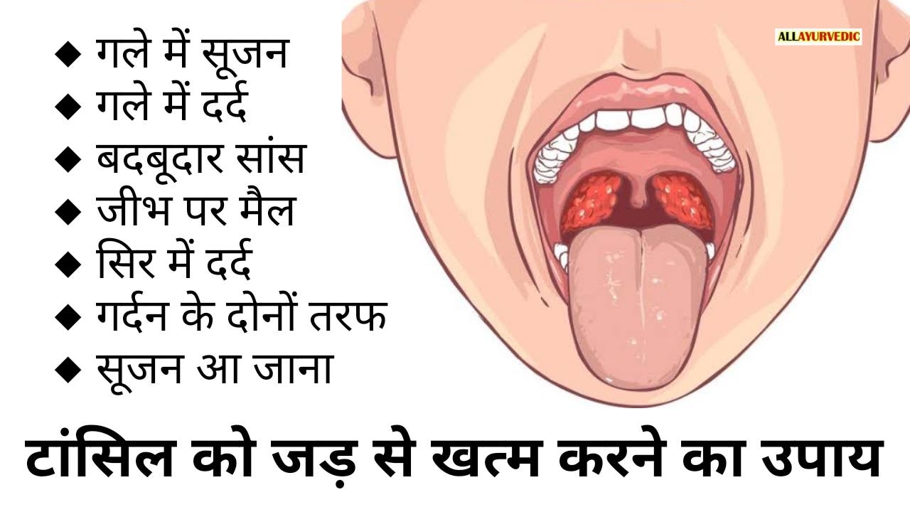 गले की सूजन में